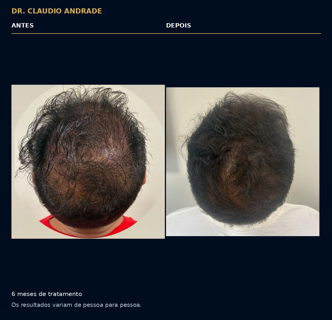 Antes e depois de seis meses de tratamento capilar. Os resultados variam de pessoa para pessoa.