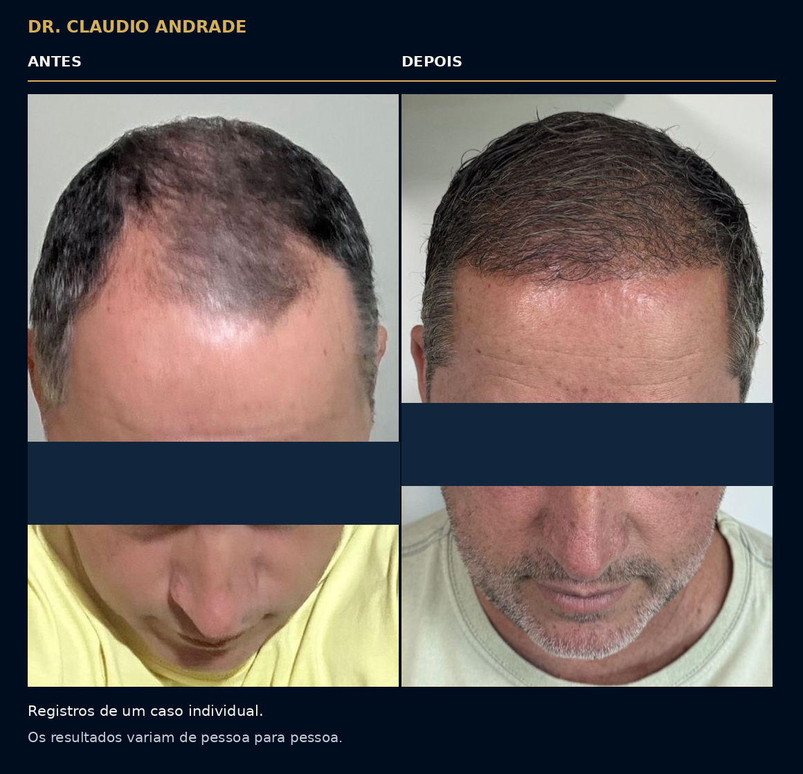 Comparativo frontal de um caso individual. Os resultados variam de pessoa para pessoa.