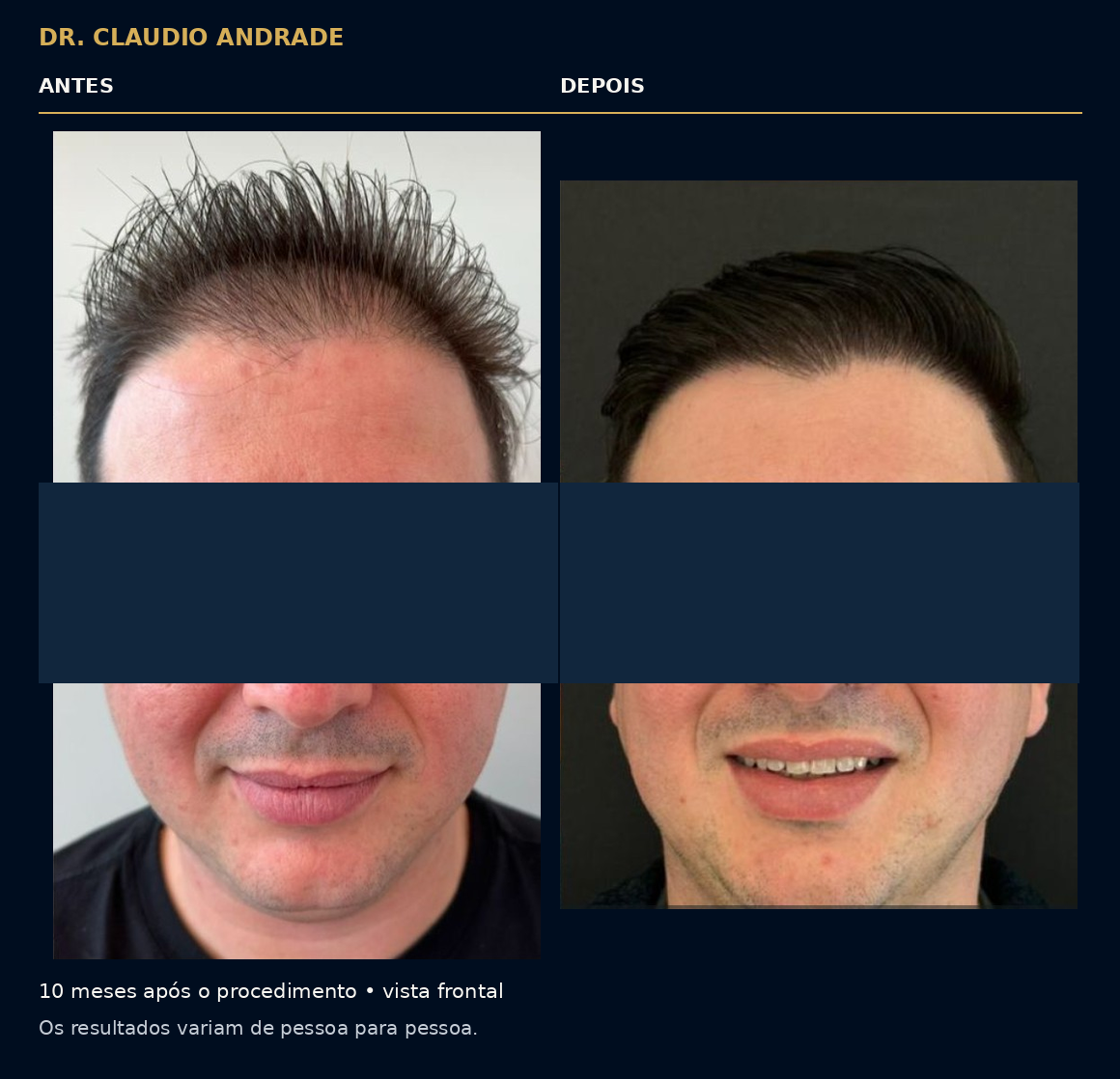 Comparativo em vista frontal, dez meses após o procedimento. Os resultados variam de pessoa para pessoa.