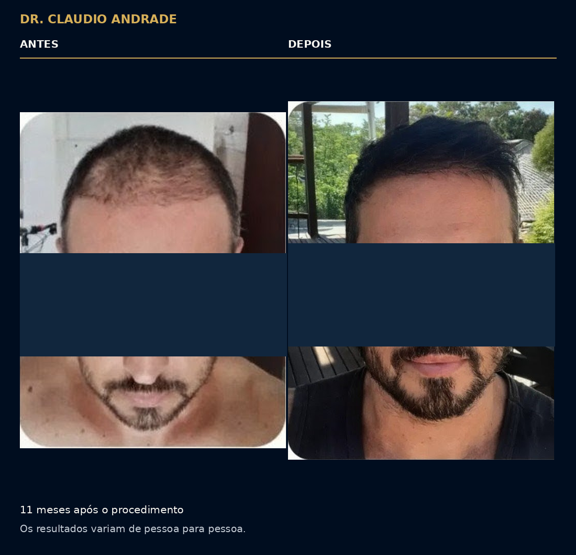 Comparativo onze meses após o procedimento. Os resultados variam de pessoa para pessoa.