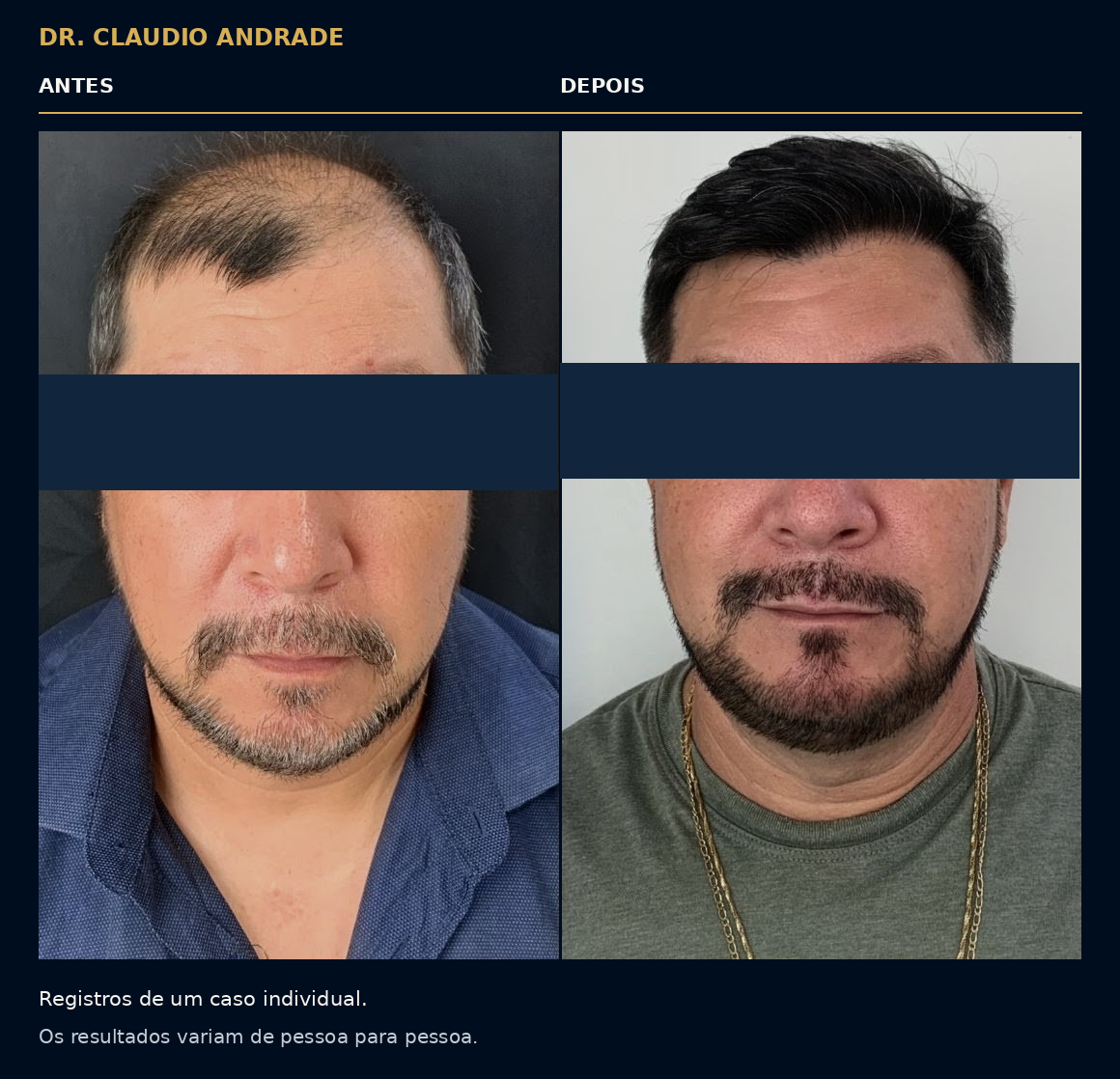 Antes e depois de um caso individual. Os resultados variam de pessoa para pessoa.