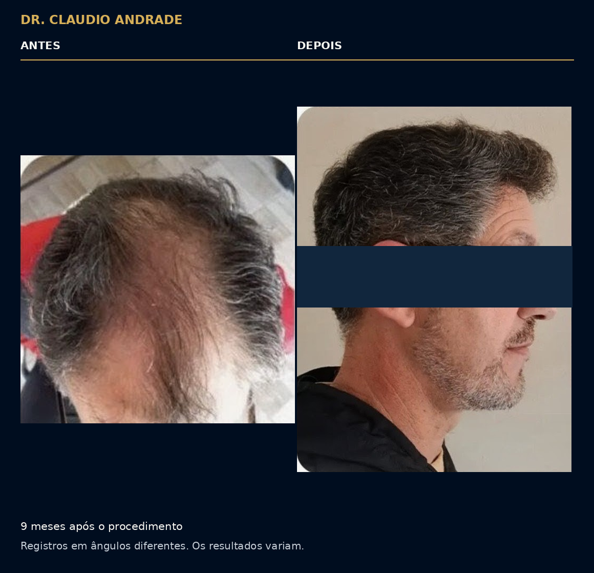Comparativo nove meses após o procedimento, com registros em ângulos diferentes. Os resultados variam.