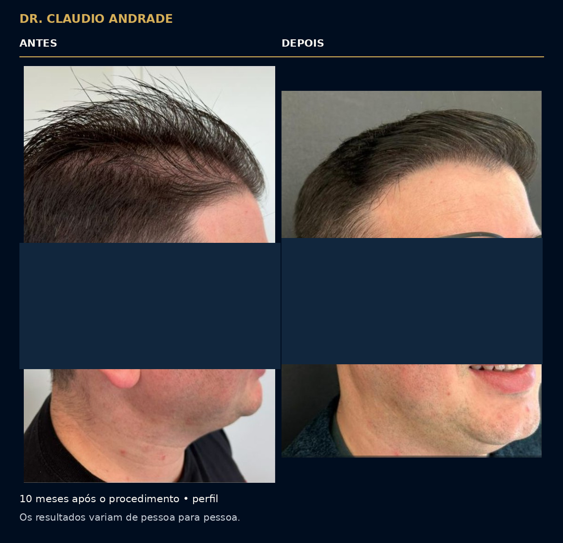 Comparativo de perfil, dez meses após o procedimento. Os resultados variam de pessoa para pessoa.